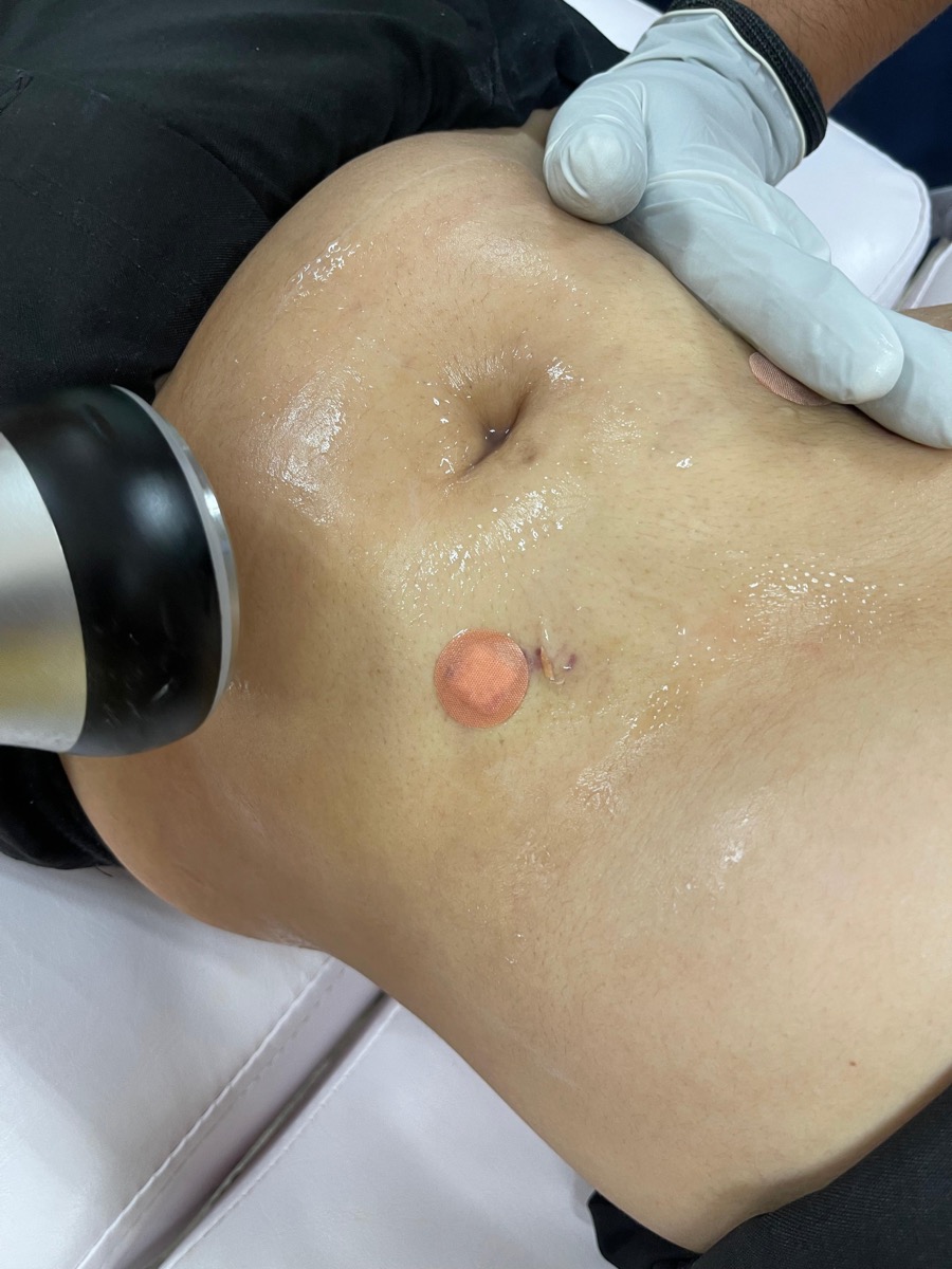 Sesión de cavitación corporal en abdomen
