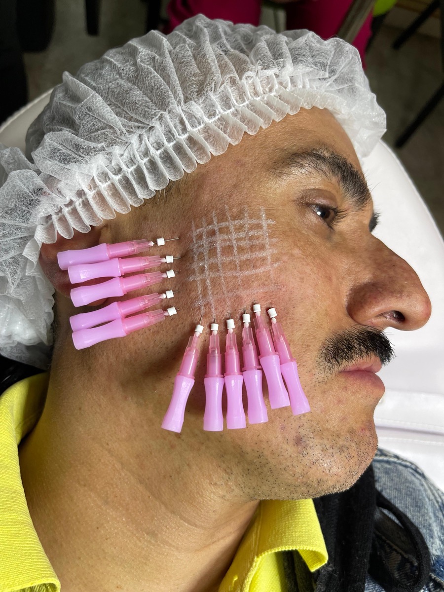 Mesoterapia facial con microagujas aplicada en mejilla