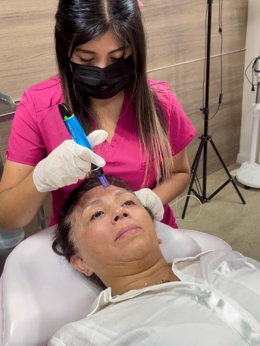 Aplicación de microneedling con dermapen en la frente